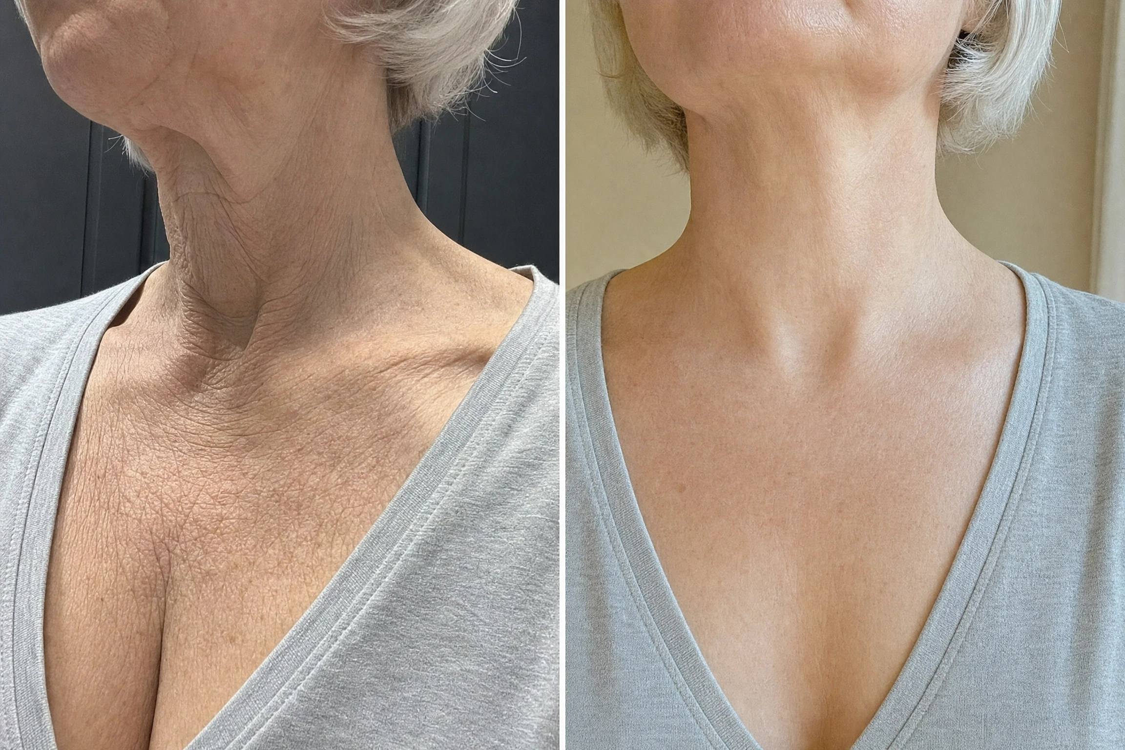 Two photographs of the same woman's neck and décolletage side by side, showing the appearance of the skin before and after a period of use